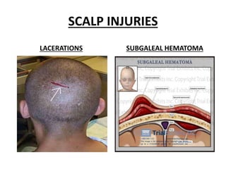 SCALP INJURIES
LACERATIONS SUBGALEAL HEMATOMA
 