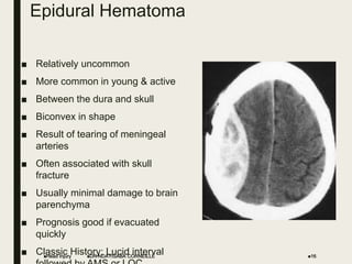 Epidural Hematoma
■ Relatively uncommon
■ More common in young & active
■ Between the dura and skull
■ Biconvex in shape
■ Result of tearing of meningeal
arteries
■ Often associated with skull
fracture
■ Usually minimal damage to brain
parenchyma
■ Prognosis good if evacuated
quickly
■ Classic History: Lucid interval
Head Injury 16
DR NDAYISABA CORNEILLE
 