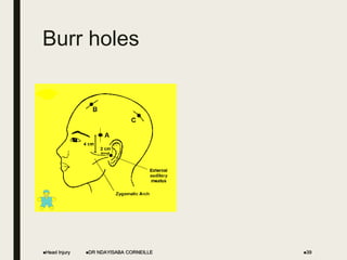 Burr holes
Head Injury DR NDAYISABA CORNEILLE 39
 