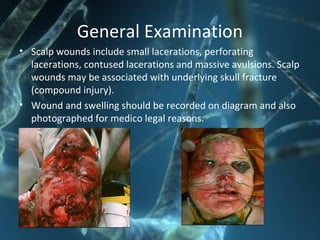 General Examination
• Scalp wounds include small lacerations, perforating
lacerations, contused lacerations and massive avulsions. Scalp
wounds may be associated with underlying skull fracture
(compound injury).
• Wound and swelling should be recorded on diagram and also
photographed for medico legal reasons.
 