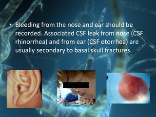 • Bleeding from the nose and ear should be
recorded. Associated CSF leak from nose (CSF
rhinorrhea) and from ear (CSF otorrhea) are
usually secondary to basal skull fractures.
 