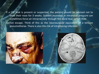 If a CSF leak is present or suspected, the patient should be advised not to
blow their nose for 3 weeks. Sudden increases in intranasal pressure can
sometimes force air intracranially through the dural tear, which then
cannot escape. Think of this as the neurosurgical equivalent of a tension
pneumothorax. There is also the risk of introducing infection.
 