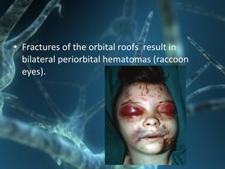 • Fractures of the orbital roofs result in
bilateral periorbital hematomas (raccoon
eyes).
 