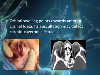 • Orbital swelling points towards anterior
cranial fossa. Its auscultation may detect
carotid-cavernous fistula.
 