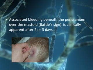 • Associated bleeding beneath the pericranium
over the mastoid (Battle’s sign) is clinically
apparent after 2 or 3 days.
 
