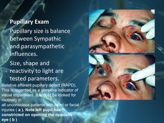 Pupillary Exam
Pupillary size is balance
between Sympathic
and parasympathetic
influences.
Size, shape and
reactivity to light are
tested parameters.
Relative afferent pupillary defect (RAPD).
This is regarded as a sensitive indicator of
visual impairment. It should be looked for
routinely in
all unconscious patients with head or facial
injuries ( a ). Note left pupil has
constricted on opening the opposite
eye ( b )
 