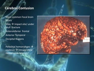 Cerebral Contusion
Most common Focal brain
Injury
Sites  Impact site/ under
skull fracture
Anteroinferior frontal
Anterior Temporal
Occipital Regions
Petechial hemorrahges 
coalesce  Intracerebral
Hematomas later on.
 