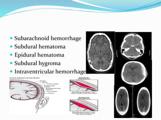 Subdural Classification Head injury classification & grading | PPTX