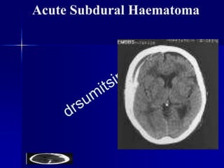 Acute Subdural Haematoma
 