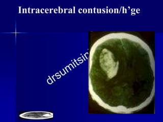 Intracerebral contusion/h’ge
 