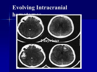 Evolving Intracranial
hematomas
2 days later
 