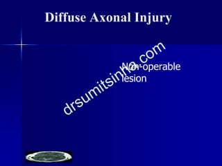 Diffuse Axonal Injury
Non-operable
lesion
 