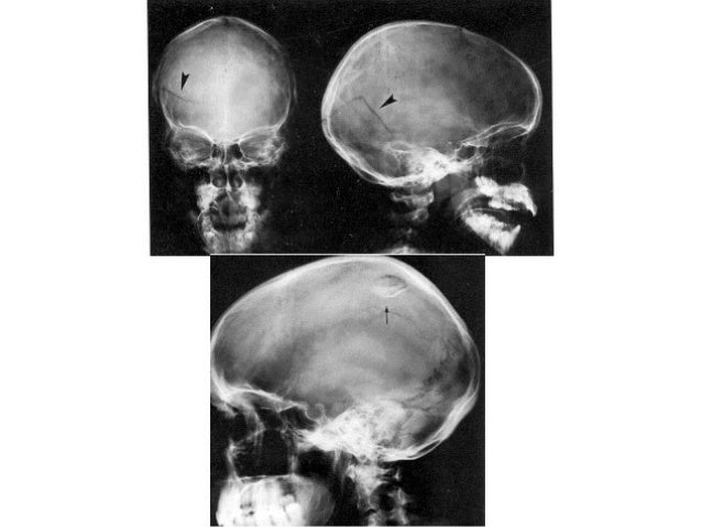 Трещина черепа у ребенка. Оскольчатый перелом черепа рентген. Диплоические вены черепа рентген. Перелом затылочной кости. Переломы костей свода черепа у детей рентген.