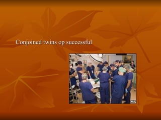 Conjoined twins op successful