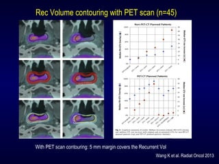 Rec Volume contouring with PET scan (n=45)
With PET scan contouring: 5 mm margin covers the Recurrent Vol
Wang K et al. Radiat Oncol 2013
 
