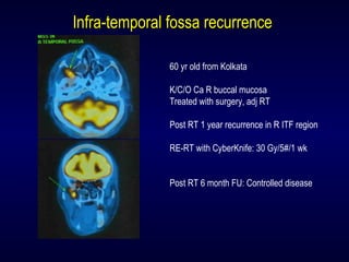 Infra-temporal fossa recurrenceInfra-temporal fossa recurrence
60 yr old from Kolkata
K/C/O Ca R buccal mucosa
Treated with surgery, adj RT
Post RT 1 year recurrence in R ITF region
RE-RT with CyberKnife: 30 Gy/5#/1 wk
Post RT 6 month FU: Controlled disease
 