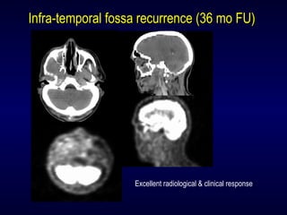 Excellent radiological & clinical response
Infra-temporal fossa recurrence (36 mo FU)Infra-temporal fossa recurrence (36 mo FU)
 