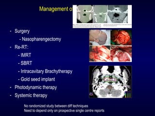 Management of ONLY local recurrence
- Surgery
- Nasopharengectomy
- Re-RT:
- IMRT
- SBRT
- Intracavitary Brachytherapy
- Gold seed implant
- Photodynamic therapy
- Systemic therapy
No randomized study between diff techniques
Need to depend only on prospective single centre reports
 