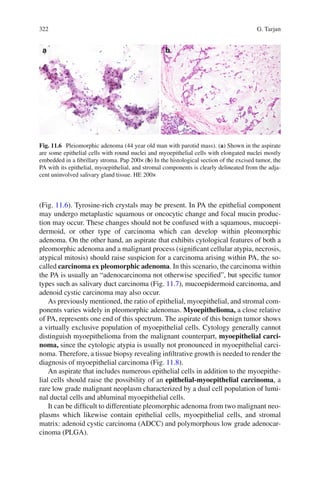 322 G. Tarjan
(Fig. 11.6). Tyrosine-rich crystals may be present. In PA the epithelial component
may undergo metaplastic squamous or oncocytic change and focal mucin produc-
tion may occur. These changes should not be confused with a squamous, mucoepi-
dermoid, or other type of carcinoma which can develop within pleomorphic
adenoma. On the other hand, an aspirate that exhibits cytological features of both a
pleomorphic adenoma and a malignant process (signiﬁcant cellular atypia, necrosis,
atypical mitosis) should raise suspicion for a carcinoma arising within PA, the so-
called carcinoma ex pleomorphic adenoma. In this scenario, the carcinoma within
the PA is usually an “adenocarcinoma not otherwise speciﬁed”, but speciﬁc tumor
types such as salivary duct carcinoma (Fig. 11.7), mucoepidermoid carcinoma, and
adenoid cystic carcinoma may also occur.
As previously mentioned, the ratio of epithelial, myoepithelial, and stromal com-
ponents varies widely in pleomorphic adenomas. Myoepithelioma, a close relative
of PA, represents one end of this spectrum. The aspirate of this benign tumor shows
a virtually exclusive population of myoepithelial cells. Cytology generally cannot
distinguish myoepithelioma from the malignant counterpart, myoepithelial carci-
noma, since the cytologic atypia is usually not pronounced in myoepithelial carci-
noma. Therefore, a tissue biopsy revealing inﬁltrative growth is needed to render the
diagnosis of myoepithelial carcinoma (Fig. 11.8).
An aspirate that includes numerous epithelial cells in addition to the myoepithe-
lial cells should raise the possibility of an epithelial-myoepithelial carcinoma, a
rare low grade malignant neoplasm characterized by a dual cell population of lumi-
nal ductal cells and abluminal myoepithelial cells.
It can be difﬁcult to differentiate pleomorphic adenoma from two malignant neo-
plasms which likewise contain epithelial cells, myoepithelial cells, and stromal
matrix: adenoid cystic carcinoma (ADCC) and polymorphous low grade adenocar-
cinoma (PLGA).
Fig. 11.6 Pleiomorphic adenoma (44 year old man with parotid mass). (a) Shown in the aspirate
are some epithelial cells with round nuclei and myoepithelial cells with elongated nuclei mostly
embedded in a ﬁbrillary stroma. Pap 200× (b) In the histological section of the excised tumor, the
PA with its epithelial, myoepithelial, and stromal components is clearly delineated from the adja-
cent uninvolved salivary gland tissue. HE 200×
 