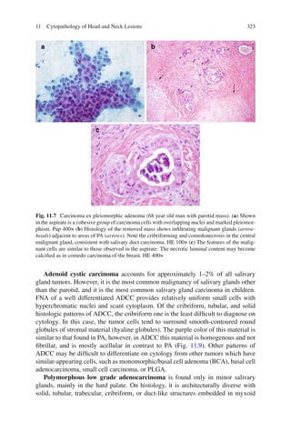 32311 Cytopathology of Head and Neck Lesions
Adenoid cystic carcinoma accounts for approximately 1–2% of all salivary
gland tumors. However, it is the most common malignancy of salivary glands other
than the parotid, and it is the most common salivary gland carcinoma in children.
FNA of a well differentiated ADCC provides relatively uniform small cells with
hyperchromatic nuclei and scant cytoplasm. Of the cribriform, tubular, and solid
histologic patterns of ADCC, the cribriform one is the least difﬁcult to diagnose on
cytology. In this case, the tumor cells tend to surround smooth-contoured round
globules of stromal material (hyaline globules). The purple color of this material is
similar to that found in PA, however, in ADCC this material is homogenous and not
ﬁbrillar, and is mostly acellular in contrast to PA (Fig. 11.9). Other patterns of
ADCC may be difﬁcult to differentiate on cytology from other tumors which have
similar-appearing cells, such as monomorphic/basal cell adenoma (BCA), basal cell
adenocarcinoma, small cell carcinoma, or PLGA.
Polymorphous low grade adenocarcinoma is found only in minor salivary
glands, mainly in the hard palate. On histology, it is architecturally diverse with
solid, tubular, trabecular, cribriform, or duct-like structures embedded in myxoid
Fig. 11.7 Carcinoma ex pleiomorphic adenoma (68 year old man with parotid mass). (a) Shown
in the aspirate is a cohesive group of carcinoma cells with overlapping nuclei and marked pleiomor-
phism. Pap 400× (b) Histology of the removed mass shows inﬁltrating malignant glands (arrow-
heads) adjacent to areas of PA (arrows). Note the cribriforming and comedonecrosis in the central
malignant gland, consistent with salivary duct carcinoma. HE 100× (c) The features of the malig-
nant cells are similar to those observed in the aspirate. The necrotic luminal content may become
calciﬁed as in comedo carcinoma of the breast. HE 400×
 