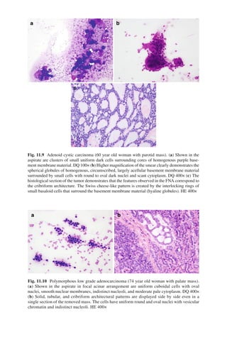 325
Fig. 11.9 Adenoid cystic carcinoma (60 year old woman with parotid mass). (a) Shown in the
aspirate are clusters of small uniform dark cells surrounding cores of homogenous purple base-
ment membrane material. DQ 100× (b) Higher magniﬁcation of the smear clearly demonstrates the
spherical globules of homogenous, circumscribed, largely acellular basement membrane material
surrounded by small cells with round to oval dark nuclei and scant cytoplasm. DQ 400× (c) The
histological section of the tumor demonstrates that the features observed in the FNA correspond to
the cribriform architecture. The Swiss cheese-like pattern is created by the interlocking rings of
small basaloid cells that surround the basement membrane material (hyaline globules). HE 400×
Fig. 11.10 Polymorphous low grade adenocarcinoma (74 year old woman with palate mass).
(a) Shown in the aspirate in focal acinar arrangement are uniform cuboidal cells with oval
nuclei, smooth nuclear membranes, indistinct nucleoli, and moderate pale cytoplasm. DQ 400×
(b) Solid, tubular, and cribriform architectural patterns are displayed side by side even in a
single section of the removed mass. The cells have uniform round and oval nuclei with vesicular
chromatin and indistinct nucleoli. HE 400×
 