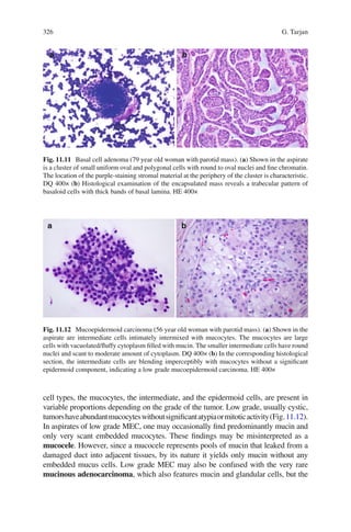 326 G. Tarjan
cell types, the mucocytes, the intermediate, and the epidermoid cells, are present in
variable proportions depending on the grade of the tumor. Low grade, usually cystic,
tumorshaveabundantmucocyteswithoutsigniﬁcantatypiaormitoticactivity(Fig.11.12).
In aspirates of low grade MEC, one may occasionally ﬁnd predominantly mucin and
only very scant embedded mucocytes. These ﬁndings may be misinterpreted as a
mucocele. However, since a mucocele represents pools of mucin that leaked from a
damaged duct into adjacent tissues, by its nature it yields only mucin without any
embedded mucus cells. Low grade MEC may also be confused with the very rare
mucinous adenocarcinoma, which also features mucin and glandular cells, but the
Fig. 11.11 Basal cell adenoma (79 year old woman with parotid mass). (a) Shown in the aspirate
is a cluster of small uniform oval and polygonal cells with round to oval nuclei and ﬁne chromatin.
The location of the purple-staining stromal material at the periphery of the cluster is characteristic.
DQ 400× (b) Histological examination of the encapsulated mass reveals a trabecular pattern of
basaloid cells with thick bands of basal lamina. HE 400×
Fig. 11.12 Mucoepidermoid carcinoma (56 year old woman with parotid mass). (a) Shown in the
aspirate are intermediate cells intimately intermixed with mucocytes. The mucocytes are large
cells with vacuolated/ﬂuffy cytoplasm ﬁlled with mucin. The smaller intermediate cells have round
nuclei and scant to moderate amount of cytoplasm. DQ 400× (b) In the corresponding histological
section, the intermediate cells are blending imperceptibly with mucocytes without a signiﬁcant
epidermoid component, indicating a low grade mucoepidermoid carcinoma. HE 400×
 