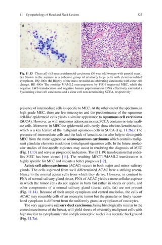 32711 Cytopathology of Head and Neck Lesions
presence of intermediate cells is speciﬁc to MEC. At the other end of the spectrum, in
high grade MEC, there are few mucocytes and the predominance of the squamous
cell-like epidermoid cells yields a similar appearance to squamous cell carcinoma
(SCCA). However, as with mucinous adenocarcinoma, SCCA contains no intermedi-
ate cells. Moreover, in MEC the epidermoid cells rarely show obvious keratinization,
which is a key feature of the malignant squamous cells in SCCA (Fig. 11.26a). The
presence of intermediate cells and the lack of keratinization also help to distinguish
MEC from the more aggressive adenosquamous carcinoma which contains malig-
nant glandular elements in addition to malignant squamous cells. In the future, molec-
ular studies of ﬁne-needle aspirates may assist in rendering the diagnosis of MEC
(Fig. 11.13) and serve as prognostic indicators. The t(11;19) translocation that under-
lies MEC has been cloned [11]. The resulting MECT1/MAML2 translocation is
highly speciﬁc for MEC and imparts a better prognosis [12].
Acinic cell adenocarcinoma (ACAC) occurs in both major and minor salivary
glands. The cells aspirated from well differentiated ACAC bear a striking resem-
blance to the normal acinar cells from which they derive. However, in contrast to
FNA of normal salivary gland tissue, FNA of ACAC yields a more cellular aspirate
in which the tumor cells do not appear in balls but rather in sheets or cords, and
other components of a normal salivary gland (ductal cells, fat) are not present
(Fig. 11.14). Because of their ample cytoplasm and central nucleolus, the cells of
ACAC may resemble cells of an oncocytic tumor but the granular or ﬁnely vacuo-
lated cytoplasm is different from the uniformly granular cytoplasm of oncocytes.
The very aggressive salivary duct carcinoma, being histologically similar to the
comedocarcinoma of the breast, will yield sheets of obviously malignant cells with
high nuclear to cytoplasmic ratio and pleiomorphic nuclei in a necrotic background
(Fig. 11.7a).
Fig. 11.13 Clear cell-rich mucoepidermoid carcinoma (56 year old woman with parotid mass).
(a) Shown in the aspirate is a cohesive group of relatively large cells with clear/vacuolated
cytoplasm. DQ 400× (b) Biopsy of the mass revealed an inﬁltrating carcinoma with clear cell
change. HE 400× The positive MAML2 rearrangement by FISH supported MEC, while the
negative EWS translocation and negative human papillomavirus DNA effectively excluded a
hyalinizing clear cell carcinoma and a clear cell non-keratinizing SCCA, respectively
 