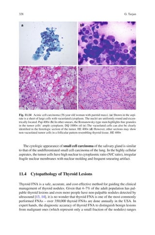 328 G. Tarjan
The cytologic appearance of small cell carcinoma of the salivary gland is similar
to that of the undifferentiated small cell carcinoma of the lung. In the highly cellular
aspirates, the tumor cells have high nuclear to cytoplasmic ratio (N/C ratio), irregular
fragile nuclear membranes with nuclear molding and frequent smearing artifact.
11.4 Cytopathology of Thyroid Lesions
Thyroid FNA is a safe, accurate, and cost-effective method for guiding the clinical
management of thyroid nodules. Given that 4–7% of the adult population has pal-
pable thyroid lesions and even more people have non-palpable nodules detected by
ultrasound [13, 14], it is no wonder that thyroid FNA is one of the most commonly
performed FNAs – over 350,000 thyroid FNAs are done annually in the USA. In
expert hands, the diagnostic accuracy of thyroid FNA to distinguish benign lesions
from malignant ones (which represent only a small fraction of the nodules) ranges
Fig. 11.14 Acinic cell carcinoma (56 year old woman with parotid mass). (a) Shown in the aspi-
rate is a sheet of large cells with vacuolated cytoplasm. The nuclei are uniformly round and excen-
trically located. Pap 400× (b) In other smears, the Romanowsky-type stain highlights ﬁne granules
in the tumor cells’ ample cytoplasm. DQ 1000× oil (c) The vacuolated cells can also be clearly
identiﬁed in the histologic section of the tumor. HE 400× (d) However, other sections may show
non-vacuolated tumor cells in a follicular pattern resembling thyroid tissue. HE 400×
 