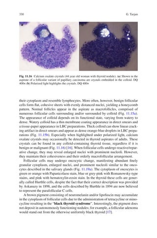 330 G. Tarjan
their cytoplasm and resemble lymphocytes. More often, however, benign follicular
cells form ﬂat, cohesive sheets with evenly distanced nuclei, yielding a honeycomb
pattern. Normal follicles appear in the aspirate as macrofollicles, comprised of
numerous follicular cells surrounding and/or surrounded by colloid (Fig. 11.15a).
The appearance of colloid depends on its functional state, varying from watery to
dense. Watery colloid has a thin membrane coating appearance in direct smears and
a tissue-paper appearance in LBC preparations. Thick colloid can show linear crack-
ing artifact in direct smears and appear as dense orange-blue droplets in LBC prepa-
rations (Fig. 11.15b). Especially when highlighted under polarized light, calcium
oxalate crystals may occasionally be detected in thyroid aspirates of adults. These
crystals can be found in any colloid-containing thyroid tissue, regardless if it is
benign or malignant (Fig. 11.16) [16]. When follicular cells undergo reactive/repar-
ative change, they may reveal enlarged nuclei with prominent nucleoli. However,
they maintain their cohesiveness and their orderly macrofollicular arrangement.
Follicular cells may undergo oncocytic change, manifesting abundant ﬁnely
granular cytoplasm, enlarged nuclei, and prominent nucleoli similar to the onco-
cytes described in the salivary glands (Fig. 11.19a). The cytoplasm of oncocytes is
green or orange with Papanicolaou stain, blue or grey-pink with Romanowsky-type
stains, and pink with hematoxylin-eosin stain. In the thyroid these cells are gener-
ally called Hurthle cells, despite the fact that their correct description was provided
by Askanazy in 1898, and the cells described by Hurthle in 1894 are now believed
to represent the parafollicular C cells.
A brown pigment consisting of neuromelanin and/or lipofuscin may accumulate
in the cytoplasm of follicular cells due to the administration of tetracycline or mino-
cycline resulting in the “black thyroid syndrome”. Interestingly, the pigment does
not deposit in autonomously functioning nodules; for example, a follicular adenoma
would stand out from the otherwise uniformly black thyroid [17].
Fig. 11.16 Calcium oxalate crystals (44 year old woman with thyroid nodule). (a) Shown in the
aspirate of a follicular variant of papillary carcinoma are crystals embedded in the colloid. DQ
400× (b) Polarized light highlights the crystals. DQ 400×
 