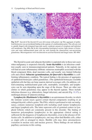 33111 Cytopathology of Head and Neck Lesions
The thyroid in acute and subacute thyroiditis is aspirated only in those rare cases
when malignancy is suspected clinically. Acute thyroiditis is an infectious condi-
tion usually seen in immunocompromised patients. Naturally, in the aspirate one
will ﬁnd an acute inﬂammatory inﬁltrate: numerous neutrophils associated with the
blood component ﬁbrin, dead (necrotic) cells, and usually very limited follicular
cells and colloid. Subacute (granulomatous, de Quervain’s) thyroiditis is a self-
limiting inﬂammatory condition. The typical ﬁnding is the presence of aggregates
of epithelioid histiocytes called granulomas. (The epithelioid histiocytes resemble
epithelial cells but they are bone marrow-derived scavenger cells.) In addition, col-
loid-containing multinucleated giant cells, neutrophils, eosinophils, and lympho-
cytes can be seen depending upon the stage of the disease. There are other rare
entities in which granulomas may appear in the thyroid aspirate. These include
infectious diseases (e.g. tuberculosis, fungal infection), and sarcoid (Fig. 11.17), a
multiorgan disease of unknown etiology.
Lymphocytic (Hashimoto’s) thyroiditis is an autoimmune disorder, in which
the immune system reacts against certain thyroid components resulting in an
enlarged thyroid, called a goiter. The FNA, which is performed to rule out malig-
nancy, contains numerous lymphoid cells including small mature lymphocytes
and larger lymphoid cells. The latter represent cells of germinal centers in lym-
phoid follicles which are commonly present in this disorder. The ﬁnding of
numerous polymorphous lymphocytes in the appropriate clinical setting is
sufﬁcient for the diagnosis of lymphocytic thyroiditis, even in the absence of fol-
licular cells. In addition to lymphocytes, one may often ﬁnd Hurthle cells, either
as single cells or arranged in sheets. Hurthle cells may show anisonucleosis
(variation in nuclear size) and nuclear grooves. These ﬁndings do not indicate
papillary carcinoma in this setting.
Fig. 11.17 Sarcoid of the thyroid (52 year old woman with goiter). (a) This aggregate of epithe-
lioid histiocytes was an incidental ﬁnding in the aspirate of a multinodular goiter. The cells are oval
to spindle shaped with elongated large pale nuclei, moderate amount of cytoplasm and indistinct
cell membranes. Pap 400× (b) In the corresponding histological section, tight clusters of histio-
cytes and some multinucleated giant cells are seen forming the characteristic non-necrotizing
granulomas. Microorganisms were not detected on acid fast bacterial and fungal stains. HE 400×
 