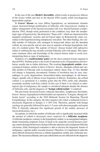 332 G. Tarjan
In the case of the rare Riedel’s thyroiditis, which results in progressive ﬁbrosis
of the tissues within and next to the thyroid, FNA usually yields non-diagnostic
hypocellular aspirate.
In Graves’ disease (or toxic diffuse hyperplasia), an autoimmune stimulus
causes increased benign proliferation of follicular cells (hyperplasia), leading to
diffuse enlargement of the thyroid associated with toxic thyroid hormone overpro-
duction. FNA, though rarely performed in this condition, may show the morpho-
logic signs of hyperactivity: the distinctive “ﬂame cells”, which are characterized by
marginal cytoplasmic vacuoles and red frayed edges on Romanowsky stains sec-
ondary to the hyperfunctioning endoplasmic reticulum. The other ﬁndings, the vari-
able number of follicular cells arranged in honeycomb sheets and the abundant
colloid, are non-speciﬁc and are also seen in aspirates of benign hyperplastic nod-
ules of a nodular goiter. The aspirate of Graves’ disease treated with radioactive
iodine or carbimazole may include crowded follicular cells with atypia. This repre-
sents treatment effect and knowledge of the clinical history helps to avoid over-
interpreting them as signs of malignancy.
Nodule(s) of a (multi)nodular goiter are the most common lesions targeted in
thyroid FNA. Nodular goiter is the result of repeated cycles of hyperplasia and invo-
lution, usually due to iodine deﬁciency. The resulting hyperplastic nodules show
cytological features similar to those in Graves’ disease: abundant colloid and vari-
able number of follicular cells in monolayer orderly sheets (Fig. 11.15a). Hurthle
cell change is frequently encountered. Features of involution may be seen: mac-
rophages in cystic degeneration; hemosiderin-laden macrophages in old hemor-
rhages; spindle cells or ﬁbrous tissue fragments in ﬁbrosis. Sometimes, the colloid
content is so prominent in a nodular goiter that the FNA yields only abundant,
essentially acellular (cell-free) colloid. In this case if there is no clinical or radio-
logical sign of malignancy, the sample is considered adequate despite the absence
of follicular cells, and the diagnosis of “benign colloid nodule” is rendered.
The previously discussed lesions (subacute thyroiditis, lymphocytic thyroiditis,
Graves’ disease, hyperplastic/colloid nodule) are reported as “Category: Benign fol-
licular lesion” according to the 2010 Bethesda System for Reporting Thyroid
Cytopathology. In this category, the false-negative rate (when a malignant lesion is
incorrectly diagnosed as benign) is 1–10% [18]. Therefore, patients with benign
cytology are generally followed for up to 3–5 years with ultrasonography and repeat
FNA if clinically indicated (for signiﬁcant growth of the nodule, presence of
microcalciﬁcations, etc.).
An aspirate, in which the number of follicular cells is signiﬁcantly increased while
the amount of colloid is decreased, raises suspicion for a follicular neoplasm.
A follicular neoplasm, contrary to the hyperplastic nodule, is an unregulated indepen-
dently functioning neoplastic lesion. It needs to be surgically excised because cytol-
ogy cannot distinguish between a benign follicular adenoma and a malignant follicular
carcinoma. (Only histological evaluation is able to disclose the diagnostic feature of
malignancy: capsular and/or vascular invasion.) Therefore, it is important to make the
often difﬁcult distinction between a cellular hyperplastic nodule and a follicular neo-
plasm. The increased cellularity and scant colloid alone are not sufﬁcient for the diagnosis
 