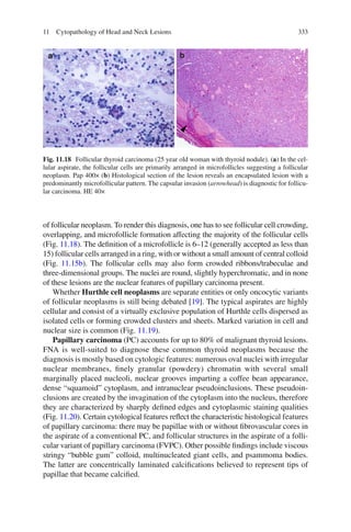 33311 Cytopathology of Head and Neck Lesions
of follicular neoplasm. To render this diagnosis, one has to see follicular cell crowding,
overlapping, and microfollicle formation affecting the majority of the follicular cells
(Fig. 11.18). The deﬁnition of a microfollicle is 6–12 (generally accepted as less than
15) follicular cells arranged in a ring, with or without a small amount of central colloid
(Fig. 11.15b). The follicular cells may also form crowded ribbons/trabeculae and
three-dimensional groups. The nuclei are round, slightly hyperchromatic, and in none
of these lesions are the nuclear features of papillary carcinoma present.
Whether Hurthle cell neoplasms are separate entities or only oncocytic variants
of follicular neoplasms is still being debated [19]. The typical aspirates are highly
cellular and consist of a virtually exclusive population of Hurthle cells dispersed as
isolated cells or forming crowded clusters and sheets. Marked variation in cell and
nuclear size is common (Fig. 11.19).
Papillary carcinoma (PC) accounts for up to 80% of malignant thyroid lesions.
FNA is well-suited to diagnose these common thyroid neoplasms because the
diagnosis is mostly based on cytologic features: numerous oval nuclei with irregular
nuclear membranes, ﬁnely granular (powdery) chromatin with several small
marginally placed nucleoli, nuclear grooves imparting a coffee bean appearance,
dense “squamoid” cytoplasm, and intranuclear pseudoinclusions. These pseudoin-
clusions are created by the invagination of the cytoplasm into the nucleus, therefore
they are characterized by sharply deﬁned edges and cytoplasmic staining qualities
(Fig. 11.20). Certain cytological features reﬂect the characteristic histological features
of papillary carcinoma: there may be papillae with or without ﬁbrovascular cores in
the aspirate of a conventional PC, and follicular structures in the aspirate of a folli-
cular variant of papillary carcinoma (FVPC). Other possible ﬁndings include viscous
stringy “bubble gum” colloid, multinucleated giant cells, and psammoma bodies.
The latter are concentrically laminated calciﬁcations believed to represent tips of
papillae that became calciﬁed.
Fig. 11.18 Follicular thyroid carcinoma (25 year old woman with thyroid nodule). (a) In the cel-
lular aspirate, the follicular cells are primarily arranged in microfollicles suggesting a follicular
neoplasm. Pap 400× (b) Histological section of the lesion reveals an encapsulated lesion with a
predominantly microfollicular pattern. The capsular invasion (arrowhead) is diagnostic for follicu-
lar carcinoma. HE 40×
 