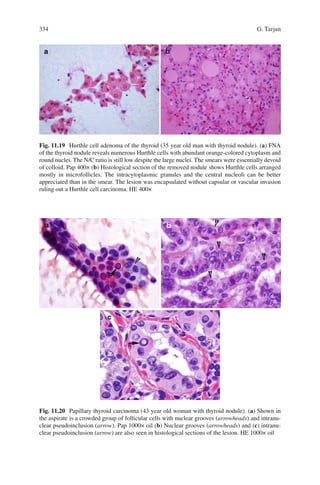 334 G. Tarjan
Fig. 11.19 Hurthle cell adenoma of the thyroid (35 year old man with thyroid nodule). (a) FNA
of the thyroid nodule reveals numerous Hurthle cells with abundant orange-colored cytoplasm and
round nuclei. The N/C ratio is still low despite the large nuclei. The smears were essentially devoid
of colloid. Pap 400× (b) Histological section of the removed nodule shows Hurthle cells arranged
mostly in microfollicles. The intracytoplasmic granules and the central nucleoli can be better
appreciated than in the smear. The lesion was encapsulated without capsular or vascular invasion
ruling out a Hurthle cell carcinoma. HE 400×
Fig. 11.20 Papillary thyroid carcinoma (43 year old woman with thyroid nodule). (a) Shown in
the aspirate is a crowded group of follicular cells with nuclear grooves (arrowheads) and intranu-
clear pseudoinclusion (arrow). Pap 1000× oil (b) Nuclear grooves (arrowheads) and (c) intranu-
clear pseudoinclusion (arrow) are also seen in histological sections of the lesion. HE 1000× oil
 