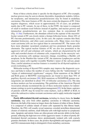 33511 Cytopathology of Head and Neck Lesions
None of these criteria alone is speciﬁc for the diagnosis of PC. (For example,
nuclear grooves may be seen in chronic thyroiditis, hyperplastic nodules, follicu-
lar neoplasms, and intranuclear pseudoinclusions may be found in medullary
carcinoma.) The more features of PC, the more certain the diagnosis of PC. False
negative diagnoses, which occur in approximately 5% of cases, are predomi-
nantly due to PC variants. In one of these, in the FVPC, the tumor is composed
of small to medium-sized follicles instead of papillae, and nuclear grooves and
intranuclear pseudoinclusions are less common than in conventional PC
(Fig. 11.16a). Furthermore, the abundant colloid in the aspirate of the macrofol-
licular variant of PC can closely mimic a benign follicular lesion. About 10% of
PCs become predominantly cystic. In this case, the aspirate contains thin ﬂuid,
abundant histiocytes, and often scant carcinoma cells. Many times even these
scant carcinoma cells are less typical than in conventional PC. The tumor cells
have more abundant vacuolated cytoplasm and less prominent ﬁnely granular
chromatin. The typical nuclear features of PC are also less prominent in the
aggressive tall cell and columnar cell variants, which are characterized by tall
cells and crowded clusters of columnar cells, respectively. In the oncocytic vari-
ant the carcinoma cells undergo oncocytic change, resembling a Hurthle cell
neoplasm. In the Warthin-like variant of PC, the numerous lymphocytes and the
oncocytic tumor cells together resemble Warthin’s tumor of the salivary gland.
Thus, careful attention to nuclear features is essential for all thyroid aspirates to
avoid overlooking a PC.
Molecular testing of thyroid FNA samples may improve the diagnostic accu-
racy and help to reduce the number of cases falling into the “indeterminate” or
“atypia of undetermined signiﬁcance” category. Point mutations of the BRAF
and RAS genes or RET/PTC rearrangements are found in more than 70% of
papillary thyroid carcinomas [20]. RAS mutations or PAX8/PPAR gamma rear-
rangements are identiﬁed in about 75% of follicular carcinomas [21]. The data
on these markers are fast accumulating. The guidelines of the American Thyroid
Association already recommend the use of these molecular markers for indeter-
minate cytology to assist in guiding patient management [22]. In the future, aspirates
of patients with PC may be tested for some markers, such as BRAF or RAS, to
select the radioactive-iodine-resistant carcinomas and to apply molecular targeted
therapy.
Poorly differentiated thyroid carcinoma, including its classic form, the insular
carcinoma, may arise from either papillary carcinoma or follicular carcinoma.
However, the bulk of the tumor no longer shows the features of either of those. Rather,
it is composed of cellular islands of tumor cells separated by thin ﬁbrous bands.
Therefore, the FNA will usually reveal numerous crowded nests/three-dimensional
clusters of relatively uniform, small follicular cells with high nuclear to cytoplasmic
ratio. Apoptotic and mitotic forms are often present with necrotic debris in the back-
ground, reﬂecting the high turn-over of this aggressive tumor. A subset of poorly dif-
ferentiated thyroid carcinomas shows predominantly isolated cells with coarsely
granular chromatin. In these cases, the positive thyroglobulin and negative calcitonin
and CEA immunostains help to distinguish it from medullary carcinoma.
 
