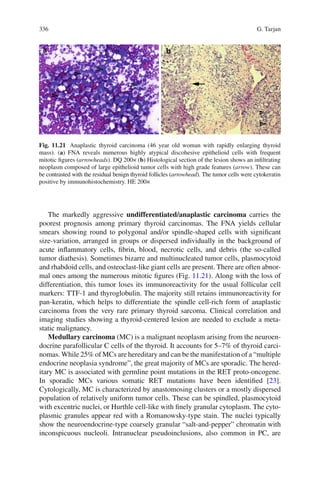 336 G. Tarjan
The markedly aggressive undifferentiated/anaplastic carcinoma carries the
poorest prognosis among primary thyroid carcinomas. The FNA yields cellular
smears showing round to polygonal and/or spindle-shaped cells with signiﬁcant
size-variation, arranged in groups or dispersed individually in the background of
acute inﬂammatory cells, ﬁbrin, blood, necrotic cells, and debris (the so-called
tumor diathesis). Sometimes bizarre and multinucleated tumor cells, plasmocytoid
and rhabdoid cells, and osteoclast-like giant cells are present. There are often abnor-
mal ones among the numerous mitotic ﬁgures (Fig. 11.21). Along with the loss of
differentiation, this tumor loses its immunoreactivity for the usual follicular cell
markers: TTF-1 and thyroglobulin. The majority still retains immunoreactivity for
pan-keratin, which helps to differentiate the spindle cell-rich form of anaplastic
carcinoma from the very rare primary thyroid sarcoma. Clinical correlation and
imaging studies showing a thyroid-centered lesion are needed to exclude a meta-
static malignancy.
Medullary carcinoma (MC) is a malignant neoplasm arising from the neuroen-
docrine parafollicular C cells of the thyroid. It accounts for 5–7% of thyroid carci-
nomas. While 25% of MCs are hereditary and can be the manifestation of a “multiple
endocrine neoplasia syndrome”, the great majority of MCs are sporadic. The hered-
itary MC is associated with germline point mutations in the RET proto-oncogene.
In sporadic MCs various somatic RET mutations have been identiﬁed [23].
Cytologically, MC is characterized by anastomosing clusters or a mostly dispersed
population of relatively uniform tumor cells. These can be spindled, plasmocytoid
with excentric nuclei, or Hurthle cell-like with ﬁnely granular cytoplasm. The cyto-
plasmic granules appear red with a Romanowsky-type stain. The nuclei typically
show the neuroendocrine-type coarsely granular “salt-and-pepper” chromatin with
inconspicuous nucleoli. Intranuclear pseudoinclusions, also common in PC, are
Fig. 11.21 Anaplastic thyroid carcinoma (46 year old woman with rapidly enlarging thyroid
mass). (a) FNA reveals numerous highly atypical discohesive epithelioid cells with frequent
mitotic ﬁgures (arrowheads). DQ 200× (b) Histological section of the lesion shows an inﬁltrating
neoplasm composed of large epithelioid tumor cells with high grade features (arrow). These can
be contrasted with the residual benign thyroid follicles (arrowhead). The tumor cells were cytokeratin
positive by immunohistochemistry. HE 200×
 