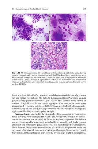 33711 Cytopathology of Head and Neck Lesions
found in at least 50% of MCs. However, careful observation of the coarsely granular
salt and pepper chromatin in MC helps to distinguish it from PC, which has pale
powdery ﬁnely granular chromatin. Up to 80% of MCs contains some amount of
amyloid. Amyloid is a ﬁbrous protein aggregate with amorphous dense waxy
appearance. It is pink and indistinguishable from dense colloid with a Romanowsky-
type stain (Fig. 11.22). However, Congo red stains amyloid orange-red with speciﬁc
apple-green birefringence under polarized light.
Paragangliomas arise within the paraganglia of the autonomic nervous system,
hence they may occur at several H&N sites. The carotid body tumor at the bifurca-
tion of the common carotid artery is the most frequently aspirated. The cellular
smears contain variably sized round to oval cells, occasionally with ﬁnely granular
chromatin and intranuclear pseudoinclusions, in a microfollicle-like arrangement.
These features may closely resemble those of a follicular neoplasm or medullary
carcinoma of the thyroid. In the case of extrathyroid paragangliomas such as carotid
body tumors, the lateral location away from the thyroid helps establish the diagnosis.
Fig. 11.22 Medullary carcinoma (61 year old man with thyroid mass). (a) Cellular smear showing
round to elongated nuclei without prominent nucleoli. DQ 200× (b) At higher magniﬁcation, amy-
loid with dense, amorphous, waxy appearance can also be appreciated in addition to the bare nuclei
of tumor cells. DQ 1000× oil (c) A representative section of the mass shows nests and sheets of
relatively uniform tumor cells with mostly round nuclei and coarsely granular chromatin next to
amyloid. HE 200×
 