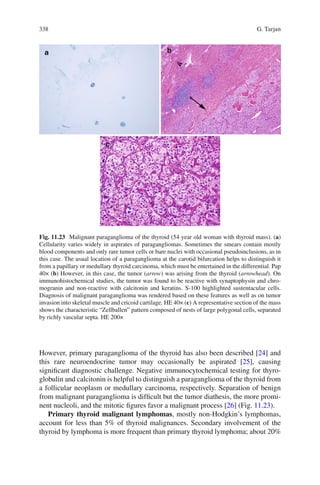 338 G. Tarjan
However, primary paraganglioma of the thyroid has also been described [24] and
this rare neuroendocrine tumor may occasionally be aspirated [25], causing
signiﬁcant diagnostic challenge. Negative immunocytochemical testing for thyro-
globulin and calcitonin is helpful to distinguish a paraganglioma of the thyroid from
a follicular neoplasm or medullary carcinoma, respectively. Separation of benign
from malignant paraganglioma is difﬁcult but the tumor diathesis, the more promi-
nent nucleoli, and the mitotic ﬁgures favor a malignant process [26] (Fig. 11.23).
Primary thyroid malignant lymphomas, mostly non-Hodgkin’s lymphomas,
account for less than 5% of thyroid malignances. Secondary involvement of the
thyroid by lymphoma is more frequent than primary thyroid lymphoma; about 20%
Fig. 11.23 Malignant paraganglioma of the thyroid (54 year old woman with thyroid mass). (a)
Cellularity varies widely in aspirates of paragangliomas. Sometimes the smears contain mostly
blood components and only rare tumor cells or bare nuclei with occasional pseudoinclusions, as in
this case. The usual location of a paraganglioma at the carotid bifurcation helps to distinguish it
from a papillary or medullary thyroid carcinoma, which must be entertained in the differential. Pap
40× (b) However, in this case, the tumor (arrow) was arising from the thyroid (arrowhead). On
immunohistochemical studies, the tumor was found to be reactive with synaptophysin and chro-
mogranin and non-reactive with calcitonin and keratins. S-100 highlighted sustentacular cells.
Diagnosis of malignant paraganglioma was rendered based on these features as well as on tumor
invasion into skeletal muscle and cricoid cartilage. HE 40× (c) A representative section of the mass
shows the characteristic “Zellballen” pattern composed of nests of large polygonal cells, separated
by richly vascular septa. HE 200×
 