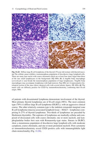 33911 Cytopathology of Head and Neck Lesions
of patients with disseminated lymphoma demonstrate involvement of the thyroid.
Most primary thyroid lymphomas are of B-cell origin (98%). The most common
type (70%) is diffuse large B-cell lymphoma (DLBCL), with an aggressive clinical
course. The other relatively common type is the indolent extranodal marginal zone
B-cell lymphoma (mucosa-associated lymphoid tissue – MALT – lymphoma) com-
prising 6–27% of thyroid lymphomas. Two-thirds of lymphomas are preceded by
Hashimoto thyroiditis. The aspirates of lymphomas are markedly cellular and com-
posed of dissociated cells with coarse chromatin, one or more nucleoli, and lym-
phoglandular bodies best seen with Romanowky-type stains. Smears in DLBCL
show a monotonous population of discohesive large lymphoid cells with moderate
cytoplasm, course chromatin, and one or more prominent nucleoli. Flow cytometry
or immunohistochemistry reveal CD20 positive cells with immunoglobulin light
chain monoclonality (Fig. 11.24).
Fig. 11.24 Diffuse large B-cell lymphoma of the thyroid (70 year old woman with thyroid mass).
(a) The cellular smear exhibits a monomorphous population of discohesive large lymphoid cells.
There are many bare nuclei with coarse chromatin which are at least four times larger than those
of the rare small lymphocytes in the background. DQ 400× (b) A tingible body macrophage
(arrowhead) is seen beside the monomorphous population of large lymphocytes. Tingible body
macrophages may accompany lymphomas with high turnover. Pap 400× (c) A representative his-
tological section of the mass shows identical cells with several mitotic ﬁgures. HE 400× (d) The
tumor cells are diffusely positive for CD20 by immunohistochemistry, conﬁrming their B-cell
origin. 400×
 