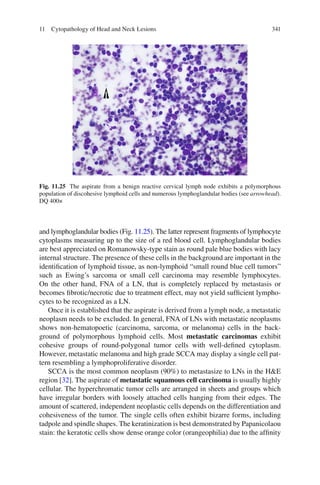 34111 Cytopathology of Head and Neck Lesions
and lymphoglandular bodies (Fig. 11.25). The latter represent fragments of lymphocyte
cytoplasms measuring up to the size of a red blood cell. Lymphoglandular bodies
are best appreciated on Romanowsky-type stain as round pale blue bodies with lacy
internal structure. The presence of these cells in the background are important in the
identiﬁcation of lymphoid tissue, as non-lymphoid “small round blue cell tumors”
such as Ewing’s sarcoma or small cell carcinoma may resemble lymphocytes.
On the other hand, FNA of a LN, that is completely replaced by metastasis or
becomes ﬁbrotic/necrotic due to treatment effect, may not yield sufﬁcient lympho-
cytes to be recognized as a LN.
Once it is established that the aspirate is derived from a lymph node, a metastatic
neoplasm needs to be excluded. In general, FNA of LNs with metastatic neoplasms
shows non-hematopoetic (carcinoma, sarcoma, or melanoma) cells in the back-
ground of polymorphous lymphoid cells. Most metastatic carcinomas exhibit
cohesive groups of round-polygonal tumor cells with well-deﬁned cytoplasm.
However, metastatic melanoma and high grade SCCA may display a single cell pat-
tern resembling a lymphoproliferative disorder.
SCCA is the most common neoplasm (90%) to metastasize to LNs in the H&E
region [32]. The aspirate of metastatic squamous cell carcinoma is usually highly
cellular. The hyperchromatic tumor cells are arranged in sheets and groups which
have irregular borders with loosely attached cells hanging from their edges. The
amount of scattered, independent neoplastic cells depends on the differentiation and
cohesiveness of the tumor. The single cells often exhibit bizarre forms, including
tadpole and spindle shapes. The keratinization is best demonstrated by Papanicolaou
stain: the keratotic cells show dense orange color (orangeophilia) due to the afﬁnity
Fig. 11.25 The aspirate from a benign reactive cervical lymph node exhibits a polymorphous
population of discohesive lymphoid cells and numerous lymphoglandular bodies (see arrowhead).
DQ 400×
 