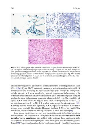 342 G. Tarjan
of keratinized squamous cells for one of the components of the Papanicolaou stain
(Fig. 11.26). Cystic SCCA metastasis can present a signiﬁcant diagnostic pitfall: if
the metastasis and eventually the entire LN undergo cystic change, the often poorly
cellular aspirates will show mostly dirty necrotic content and inﬂammatory cells
with scant anucleate or mildly atypical squamous cells. These ﬁndings can easily be
confused with an inﬂammatory process or a branchial cleft cyst. The possibility of
cystic SCCA must always be kept in mind since the frequency of cystic SCCA
metastasis varies from 9.1 to 21.5% depending on the site of the primary tumor [33].
Knowing that the patient has a primary SCCA, especially if that is in the H&N
region, helps to avoid this mistake. However, in about 2–5% of cervical SCCA
metastases, the location of the primary carcinoma is never discovered [34].
Some unique carcinoma types may also present diagnostic difﬁculties when they
metastasize to LNs. Metastasis of the Epstein-Barr virus-related undifferentiated
nasopharyngeal carcinoma may exhibit only scattered large carcinoma cells
accompanied by abundant lymphocytes, some eosinophils, and occasionally granu-
lomas [35]. Thus, it can be confused with lymphoma, especially Hodgkin’s lymphoma,
Fig. 11.26 Cervical lymph node with SCCA metastasis (50 year old man with enlarged neck LN).
(a) The aspirate contains many large atypical cells, including a tadpole-like cell, with orange-col-
ored cytoplasm and hyperchromatic nuclei. Pap 200× (b) Another smear shows the polymorphous
lymphoid population, reactive to the metastatic orange-colored squamous cells. Pap 200× (c) The
characteristic whorled pattern of SCCA and focal keratinization can be appreciated in the corre-
sponding histological section. HE 200×
 