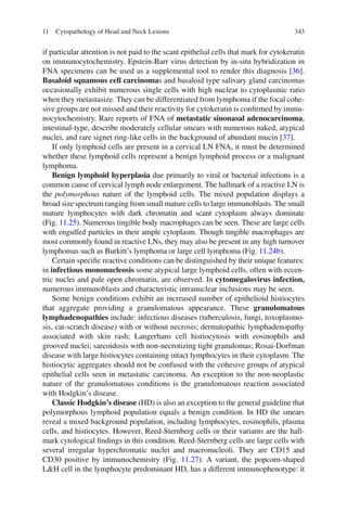34311 Cytopathology of Head and Neck Lesions
if particular attention is not paid to the scant epithelial cells that mark for cytokeratin
on immunocytochemistry. Epstein-Barr virus detection by in-situ hybridization in
FNA specimens can be used as a supplemental tool to render this diagnosis [36].
Basaloid squamous cell carcinomas and basaloid type salivary gland carcinomas
occasionally exhibit numerous single cells with high nuclear to cytoplasmic ratio
when they metastasize. They can be differentiated from lymphoma if the focal cohe-
sive groups are not missed and their reactivity for cytokeratin is conﬁrmed by immu-
nocytochemistry. Rare reports of FNA of metastatic sinonasal adenocarcinoma,
intestinal-type, describe moderately cellular smears with numerous naked, atypical
nuclei, and rare signet ring-like cells in the background of abundant mucin [37].
If only lymphoid cells are present in a cervical LN FNA, it must be determined
whether these lymphoid cells represent a benign lymphoid process or a malignant
lymphoma.
Benign lymphoid hyperplasia due primarily to viral or bacterial infections is a
common cause of cervical lymph node enlargement. The hallmark of a reactive LN is
the polymorphous nature of the lymphoid cells. The mixed population displays a
broad size spectrum ranging from small mature cells to large immunoblasts. The small
mature lymphocytes with dark chromatin and scant cytoplasm always dominate
(Fig. 11.25). Numerous tingible body macrophages can be seen. These are large cells
with engulfed particles in their ample cytoplasm. Though tingible macrophages are
most commonly found in reactive LNs, they may also be present in any high turnover
lymphomas such as Burkitt’s lymphoma or large cell lymphoma (Fig. 11.24b).
Certain speciﬁc reactive conditions can be distinguished by their unique features:
in infectious mononucleosis some atypical large lymphoid cells, often with eccen-
tric nuclei and pale open chromatin, are observed. In cytomegalovirus infection,
numerous immunoblasts and characteristic intranuclear inclusions may be seen.
Some benign conditions exhibit an increased number of epithelioid histiocytes
that aggregate providing a granulomatous appearance. These granulomatous
lymphadenopathies include: infectious diseases (tuberculosis, fungi, toxoplasmo-
sis, cat-scratch disease) with or without necrosis; dermatopathic lymphadenopathy
associated with skin rash; Langerhans cell histiocytosis with eosinophils and
grooved nuclei; sarcoidosis with non-necrotizing tight granulomas; Rosai-Dorfman
disease with large histiocytes containing intact lymphocytes in their cytoplasm. The
histiocytic aggregates should not be confused with the cohesive groups of atypical
epithelial cells seen in metastatic carcinoma. An exception to the non-neoplastic
nature of the granulomatous conditions is the granulomatous reaction associated
with Hodgkin’s disease.
Classic Hodgkin’s disease (HD) is also an exception to the general guideline that
polymorphous lymphoid population equals a benign condition. In HD the smears
reveal a mixed background population, including lymphocytes, eosinophils, plasma
cells, and histiocytes. However, Reed-Sternberg cells or their variants are the hall-
mark cytological ﬁndings in this condition. Reed-Sternberg cells are large cells with
several irregular hyperchromatic nuclei and macronucleoli. They are CD15 and
CD30 positive by immunochemistry (Fig. 11.27). A variant, the popcorn-shaped
L&H cell in the lymphocyte predominant HD, has a different immunophenotype: it
 