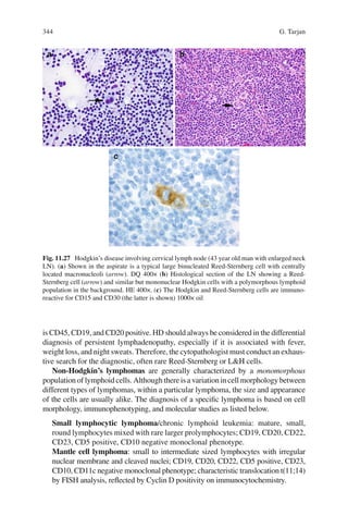 344 G. Tarjan
is CD45, CD19, and CD20 positive. HD should always be considered in the differential
diagnosis of persistent lymphadenopathy, especially if it is associated with fever,
weight loss, and night sweats. Therefore, the cytopathologist must conduct an exhaus-
tive search for the diagnostic, often rare Reed-Sternberg or L&H cells.
Non-Hodgkin’s lymphomas are generally characterized by a monomorphous
population of lymphoid cells. Although there is a variation in cell morphology between
different types of lymphomas, within a particular lymphoma, the size and appearance
of the cells are usually alike. The diagnosis of a speciﬁc lymphoma is based on cell
morphology, immunophenotyping, and molecular studies as listed below.
Small lymphocytic lymphoma/chronic lymphoid leukemia: mature, small,
round lymphocytes mixed with rare larger prolymphocytes; CD19, CD20, CD22,
CD23, CD5 positive, CD10 negative monoclonal phenotype.
Mantle cell lymphoma: small to intermediate sized lymphocytes with irregular
nuclear membrane and cleaved nuclei; CD19, CD20, CD22, CD5 positive, CD23,
CD10, CD11c negative monoclonal phenotype; characteristic translocation t(11;14)
by FISH analysis, reﬂected by Cyclin D positivity on immunocytochemistry.
Fig. 11.27 Hodgkin’s disease involving cervical lymph node (43 year old man with enlarged neck
LN). (a) Shown in the aspirate is a typical large binucleated Reed-Sternberg cell with centrally
located macronucleoli (arrow). DQ 400× (b) Histological section of the LN showing a Reed-
Sternberg cell (arrow) and similar but mononuclear Hodgkin cells with a polymorphous lymphoid
population in the background. HE 400×. (c) The Hodgkin and Reed-Sternberg cells are immuno-
reactive for CD15 and CD30 (the latter is shown) 1000× oil
 