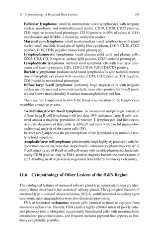 34511 Cytopathology of Head and Neck Lesions
Follicular lymphoma: small to intermediate sized lymphocytes with irregular
nuclear membrane and notched/cleaved nuclei; CD19, CD20, CD22 positive,
CD5 negative monoclonal phenotype, CD 10 positive in 60% of cases; t(14;18)
translocation and IGH/bcl-2 fusion by molecular studies.
Marginal zone lymphoma: small to intermediate sized lymphocytes with round
nuclei, small nucleoli, broad rim of lightly blue cytoplasm; CD19, CD20, CD22
positive, CD5, CD10 negative monoclonal phenotype.
Lymphoplasmocytic lymphoma: small plasmocytoid cells and plasma cells;
CD23, CD5, CD10 negative, surface IgM positive, CD20 variable phenotype.
Lymphoblastic lymphoma: medium sized lymphoid cells with blast-type chro-
matin and scant cytoplasm; CD1, CD10, CD19, TdT, CD4/CD8 positive.
Burkitt’s lymphoma: medium sized round lymphoid cells with nucleoli, narrow
rim of basophilic cytoplasm with vacuoles; CD19, CD22 positive, TdT negative,
CD10 variable monoclonal phenotype.
Diffuse large B-cell lymphoma: uniformly large atypical cells with irregular
nuclear membranes and prominent nucleoli; more often positive for B-cell mark-
ers and shows monoclonality if surface immunoglobulin is not lost.
There are rare lymphomas in which the broad size-variation of the lymphocytes
resembles a reactive process:
T-cell/histiocyte-rich B-cell lymphoma: an uncommon morphologic variant of
diffuse large B-cell lymphoma with less than 10% malignant large B cells scat-
tered amidst a majority population of reactive T lymphocytes and histiocytes.
Accurate diagnosis of this entity is difﬁcult and rests with careful immunohis-
tochemical analysis of the tumor cells [38].
In other rare lymphomas the pleiomorphism of the lymphoid cells mimics a non-
lymphoid neoplasm:
Anaplastic large cell lymphoma: pleiomorphic large highly atypical cells with fre-
quent multinucleation, horseshoe shaped nuclei, abundant cytoplasm; majority are of
T-cell, minority are of B-cell or null-cell origin with variable phenotype; characteris-
tically CD30 positive, may be EMA positive; majority harbors the translocation of
t(2:5) resulting in ALK protein dysregulation detectable by immunocytochemistry.
11.6 Cytopathology of Other Lesions of the H&N Region
The cytological features of sinonasal salivary gland-type adenocarcinomas are iden-
tical to those described in the section of salivary glands. The cytological features of
intestinal-type sinonasal adenocarcinoma, SCCA, undifferentiated nasopharyngeal
carcinoma, and paraganglioma were also discussed previously.
FNA of sinonasal melanomas reveals cells identical to those in aspirates from
cutaneous melanomas. Namely, FNA yields a highly cellular smear of poorly cohe-
sive plasmocytoid to elongated, occasionally binucleated cells with macronucleoli,
intranuclear pseudoinclusions, and frequent melanin pigment that appears as ﬁne,
dusty cytoplasmic granules.
 