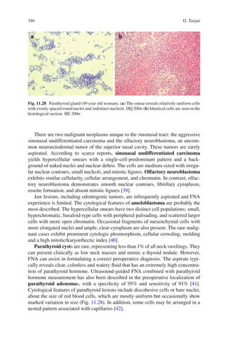 346 G. Tarjan
There are two malignant neoplasms unique to the sinonasal tract: the aggressive
sinonasal undifferentiated carcinoma and the olfactory neuroblastoma, an uncom-
mon neuroectodermal tumor of the superior nasal cavity. These tumors are rarely
aspirated. According to scarce reports, sinonasal undifferentiated carcinoma
yields hypercellular smears with a single-cell-predominant pattern and a back-
ground of naked nuclei and nuclear debris. The cells are medium-sized with irregu-
lar nuclear contours, small nucleoli, and mitotic ﬁgures. Olfactory neuroblastoma
exhibits similar cellularity, cellular arrangement, and chromatin. In contrast, olfac-
tory neuroblastoma demonstrates smooth nuclear contours, ﬁbrillary cytoplasm,
rosette formation, and absent mitotic ﬁgures [39].
Jaw lesions, including odontogenic tumors, are infrequently aspirated and FNA
experience is limited. The cytological features of ameloblastoma are probably the
most described. The hypercellular smears have two distinct cell populations: small,
hyperchromatic, basaloid-type cells with peripheral palisading, and scattered larger
cells with more open chromatin. Occasional fragments of mesenchymal cells with
more elongated nuclei and ample, clear cytoplasm are also present. The rare malig-
nant cases exhibit prominent cytologic pleomorphism, cellular crowding, molding
and a high mitotic/karyorrhectic index [40].
Parathyroid cysts are rare, representing less than 1% of all neck swellings. They
can present clinically as low neck masses and mimic a thyroid nodule. However,
FNA can assist in formulating a correct preoperative diagnosis. The aspirate typi-
cally reveals clear, colorless and watery ﬂuid that has an extremely high concentra-
tion of parathyroid hormone. Ultrasound-guided FNA combined with parathyroid
hormone measurement has also been described in the preoperative localization of
parathyroid adenomas, with a speciﬁcity of 95% and sensitivity of 91% [41].
Cytological features of parathyroid lesions include discohesive cells or bare nuclei,
about the size of red blood cells, which are mostly uniform but occasionally show
marked variation in size (Fig. 11.28). In addition, some cells may be arranged in a
nested pattern associated with capillaries [42].
Fig. 11.28 Parathyroid gland (49 year old woman). (a) The smear reveals relatively uniform cells
with evenly spaced round nuclei and indistinct nucleoli. DQ 200× (b) Identical cells are seen in the
histological section. HE 200×
 