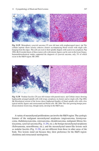 34711 Cytopathology of Head and Neck Lesions
A variety of mesenchymal proliferations can involve the H&N region. The cytologic
features of the malignant mesenchymal neoplasms (angiosarcoma, leiomyosar-
coma, rhabdomyosarcoma, osteosarcoma, chondrosarcoma, malignant ﬁbrous his-
tiocytoma, synovial sarcoma (Fig. 11.29), etc.), the benign mesenchymal neoplasms
(Schwannoma, neuroﬁbroma, etc.), and the mesenchymal tumor-like lesions such
as nodular fasciitis (Fig. 11.30), are not different from those in other areas of the
body. Two lesions stand out because they show preference for the H&N region:
chordoma and extracranial meningioma.
Fig. 11.29 Monophasic synovial sarcoma (35 year old man with oropharyngeal mass). (a) The
cellular aspirate shows loosely cohesive clusters accompanying blood vessels with single cells
hanging from the edges. The cells are oval or short spindle shaped, with scant or no cytoplasm. Pap
200× (b) Crowded sheets of these tumor cells with mitotic ﬁgures can be seen in the tissue biopsy.
Immunohistochemical studies supported the diagnosis of synovial sarcoma, only 3% of which
occur in the H&N region. HE 200×
Fig. 11.30 Nodular fasciitis (29 year old woman with parotid mass). (a) Cellular smear showing
haphazardly arranged spindle cells with wispy cytoplasm, in clusters and as single cells. Pap 200×
(b) Histological section of the lesion shows haphazard bundles of bland spindle cells with a few
typical mitotic ﬁgures and extravasated red blood cells. HE 200× This fast-growing benign pseu-
dosarcomatous lesion may, though rarely, develop in the H&N area
 