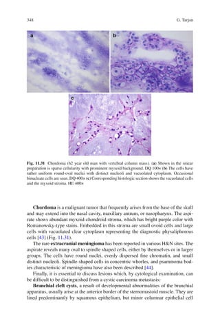 348 G. Tarjan
Chordoma is a malignant tumor that frequently arises from the base of the skull
and may extend into the nasal cavity, maxillary antrum, or nasopharynx. The aspi-
rate shows abundant myxoid-chondroid stroma, which has bright purple color with
Romanowsky-type stains. Embedded in this stroma are small ovoid cells and large
cells with vacuolated clear cytoplasm representing the diagnostic physaliphorous
cells [43] (Fig. 11.31).
The rare extracranial meningioma has been reported in various H&N sites. The
aspirate reveals many oval to spindle shaped cells, either by themselves or in larger
groups. The cells have round nuclei, evenly dispersed ﬁne chromatin, and small
distinct nucleoli. Spindle-shaped cells in concentric whorles, and psammoma bod-
ies characteristic of meningioma have also been described [44].
Finally, it is essential to discuss lesions which, by cytological examination, can
be difﬁcult to be distinguished from a cystic carcinoma metastasis:
Branchial cleft cysts, a result of developmental abnormalities of the branchial
apparatus, usually arise at the anterior border of the sternomastoid muscle. They are
lined predominantly by squamous epithelium, but minor columnar epithelial cell
Fig. 11.31 Chordoma (62 year old man with vertebral column mass). (a) Shown in the smear
preparation is sparse cellularity with prominent myxoid background. DQ 100× (b) The cells have
rather uniform round-oval nuclei with distinct nucleoli and vacuolated cytoplasm. Occasional
binucleate cells are seen. DQ 400× (c) Corresponding histologic section shows the vacuolated cells
and the myxoid stroma. HE 400×
 