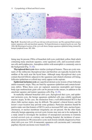 34911 Cytopathology of Head and Neck Lesions
lining may be present. FNAs of branchial cleft cysts yield thick yellow ﬂuid which
containing many anucleate squames, some squamous cells, and occasional colum-
nar cells and lymphocytes. Amorphous debris with neutrophils is commonly seen in
the background (Fig. 11.32).
Thyroglossal duct cysts show similar cytological features. These are cystic rem-
nants of the embryonic thyroglossal duct and therefore are typically located in the
midline of the neck near the hyoid bone. Although many thyroglossal duct cysts
contain thyroid follicles adjacent to the squamous and ciliated columnar cell lining,
follicular epithelium or colloid may rarely appear in the aspirate.
Epidermal inclusion cysts are superﬁcial dermal cystic lesions of hair follicular
and/or traumatic origin. They are lined by squamous epithelium and contain kerati-
nous debris. When these cysts are ruptured, numerous neutrophils and foreign
body-type multinucleate giant cells can be present in the smears, in addition to the
anucleate squames and mature squamous cells (Fig. 11.33).
In markedly inﬂamed branchial cleft cysts, thyroglossal duct cysts, and epider-
mal inclusion cysts, the benign squamous epithelial cells may exhibit signiﬁcant
reactive atypia. In this case, the distinction from a well-differentiated SCCA that
shows little nuclear atypia, may be difﬁcult. The patient’s clinical history and the
lesion’s exact location may provide some guidance. Particular attention should be
paid to make sure that features of SCCA such as increased N/C ratio, nuclear hyper-
chromasia, or nuclear membrane irregularity are not present. On the other hand,
clinically benign-appearing cervical cystic lesions may turn out to be malignant. In
a study aimed to investigate the incidence of unsuspected carcinoma in routinely
excised cervical cysts at a tertiary care teaching hospital, the incidence of unsus-
pected carcinoma in 196 consecutive cystic neck lesions initially diagnosed as bran-
chial cleft cysts was 3.6% (6 metastatic squamous cell carcinoma and 1 metastatic
papillary thyroid carcinoma were found) [45].
Fig. 11.32 Branchial cleft cyst (25 year old man with neck lesion). (a) The aspirated ﬂuid contains
mature squamous cells and anucleate squames. No hyperchromasia or atypical nuclei are seen. Pap
100× (b) Histological section of the cyst wall shows benign squamous epithelial lining rimmed by
benign lymphoid tissue. HE 100×
 