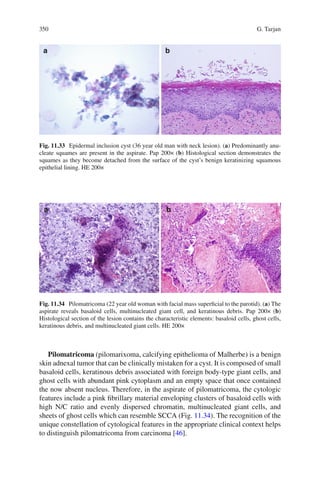 350 G. Tarjan
Pilomatricoma (pilomarixoma, calcifying epithelioma of Malherbe) is a benign
skin adnexal tumor that can be clinically mistaken for a cyst. It is composed of small
basaloid cells, keratinous debris associated with foreign body-type giant cells, and
ghost cells with abundant pink cytoplasm and an empty space that once contained
the now absent nucleus. Therefore, in the aspirate of pilomatricoma, the cytologic
features include a pink ﬁbrillary material enveloping clusters of basaloid cells with
high N/C ratio and evenly dispersed chromatin, multinucleated giant cells, and
sheets of ghost cells which can resemble SCCA (Fig. 11.34). The recognition of the
unique constellation of cytological features in the appropriate clinical context helps
to distinguish pilomatricoma from carcinoma [46].
Fig. 11.33 Epidermal inclusion cyst (36 year old man with neck lesion). (a) Predominantly anu-
cleate squames are present in the aspirate. Pap 200× (b) Histological section demonstrates the
squames as they become detached from the surface of the cyst’s benign keratinizing squamous
epithelial lining. HE 200×
Fig. 11.34 Pilomatricoma (22 year old woman with facial mass superﬁcial to the parotid). (a) The
aspirate reveals basaloid cells, multinucleated giant cell, and keratinous debris. Pap 200× (b)
Histological section of the lesion contains the characteristic elements: basaloid cells, ghost cells,
keratinous debris, and multinucleated giant cells. HE 200×
 