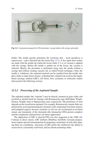 316 G. Tarjan
holder. The needle quickly penetrates the overlying skin – local anesthesia is
unnecessary – and is directed into the lesion (Fig. 11.1). A few rapid short strokes
are made with the needle tip within the lesion while 2–3 cc of vacuum is applied
with the syringe. Before the needle is pulled out of the lesion, the vacuum is
released. (Rarely, the procedure is performed using only the needle without a
syringe and without creating vacuum; the so-called French technique.) Once the
needle is withdrawn, the aspirated material can be expelled from the needle onto
glass slides to make direct smears, or ﬂushed into a liquid to be used for the liquid-
based cytology method (LBC), cell block, ﬂow cytometry or molecular studies
(discussed in the following section).
11.2.2 Processing of the Aspirated Sample
The aspirated sample (the “aspirate”) may be directly smeared on glass slides and
air-dried or alcohol ﬁxed for staining with Romanowsky-type (Diff-Quik, Wright-
Giemsa, Wright) stain or Papanicolaou stain, respectively. The preference of stain
depends on the tissue/lesion aspirated. For example, Romanowsky stained slides are
preferred for assessing hematopoetic elements (cells originating from bone marrow
and lymphoid organs), because variations in cell size are accentuated on air-dried
smears and immaturity of the chromatin (the intranuclear DNA-protein complex)
and the cytoplasmic characteristics are better appreciated.
The application of LBC to thyroid FNA was ﬁrst suggested in the 1990s [4].
Contrary to direct smears, LBC methods (ThinPrep, SurePath, Cytospin prepara-
tions) require special instrumentation for preparing a monolayer of cells after align-
ing them on a membrane. Advocates of LBC prefer this method for the ability to
screen fewer, consistently well-ﬁxed, and less blood-containing slides.
Fig. 11.1 Instruments prepared for FNA procedure: syringe holder with syringe and needle
 