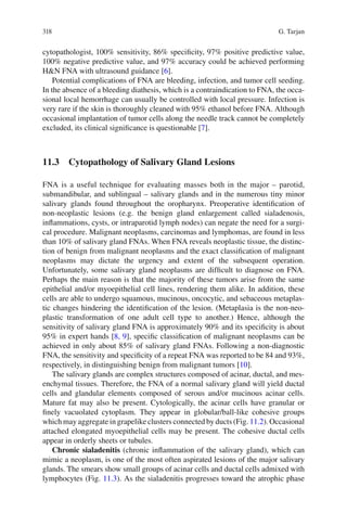 318 G. Tarjan
cytopathologist, 100% sensitivity, 86% speciﬁcity, 97% positive predictive value,
100% negative predictive value, and 97% accuracy could be achieved performing
H&N FNA with ultrasound guidance [6].
Potential complications of FNA are bleeding, infection, and tumor cell seeding.
In the absence of a bleeding diathesis, which is a contraindication to FNA, the occa-
sional local hemorrhage can usually be controlled with local pressure. Infection is
very rare if the skin is thoroughly cleaned with 95% ethanol before FNA. Although
occasional implantation of tumor cells along the needle track cannot be completely
excluded, its clinical signiﬁcance is questionable [7].
11.3 Cytopathology of Salivary Gland Lesions
FNA is a useful technique for evaluating masses both in the major – parotid,
submandibular, and sublingual – salivary glands and in the numerous tiny minor
salivary glands found throughout the oropharynx. Preoperative identiﬁcation of
non-neoplastic lesions (e.g. the benign gland enlargement called sialadenosis,
inﬂammations, cysts, or intraparotid lymph nodes) can negate the need for a surgi-
cal procedure. Malignant neoplasms, carcinomas and lymphomas, are found in less
than 10% of salivary gland FNAs. When FNA reveals neoplastic tissue, the distinc-
tion of benign from malignant neoplasms and the exact classiﬁcation of malignant
neoplasms may dictate the urgency and extent of the subsequent operation.
Unfortunately, some salivary gland neoplasms are difﬁcult to diagnose on FNA.
Perhaps the main reason is that the majority of these tumors arise from the same
epithelial and/or myoepithelial cell lines, rendering them alike. In addition, these
cells are able to undergo squamous, mucinous, oncocytic, and sebaceous metaplas-
tic changes hindering the identiﬁcation of the lesion. (Metaplasia is the non-neo-
plastic transformation of one adult cell type to another.) Hence, although the
sensitivity of salivary gland FNA is approximately 90% and its speciﬁcity is about
95% in expert hands [8, 9], speciﬁc classiﬁcation of malignant neoplasms can be
achieved in only about 85% of salivary gland FNAs. Following a non-diagnostic
FNA, the sensitivity and speciﬁcity of a repeat FNA was reported to be 84 and 93%,
respectively, in distinguishing benign from malignant tumors [10].
The salivary glands are complex structures composed of acinar, ductal, and mes-
enchymal tissues. Therefore, the FNA of a normal salivary gland will yield ductal
cells and glandular elements composed of serous and/or mucinous acinar cells.
Mature fat may also be present. Cytologically, the acinar cells have granular or
ﬁnely vacuolated cytoplasm. They appear in globular/ball-like cohesive groups
which may aggregate in grapelike clusters connected by ducts (Fig. 11.2). Occasional
attached elongated myoepithelial cells may be present. The cohesive ductal cells
appear in orderly sheets or tubules.
Chronic sialadenitis (chronic inﬂammation of the salivary gland), which can
mimic a neoplasm, is one of the most often aspirated lesions of the major salivary
glands. The smears show small groups of acinar cells and ductal cells admixed with
lymphocytes (Fig. 11.3). As the sialadenitis progresses toward the atrophic phase
 